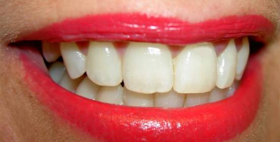 Biele zuby